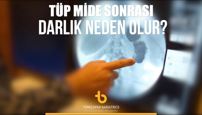 tup-mide-ameliyati-sonrasi-darlik-neden-olur