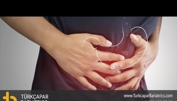 reflu,reflüdoktoru,barret,reflu cerrahisi,reflüameliyatı,saglik,hastalik,anatomi,hasta,endoskopi,ph metre,mide,doktor,özofajit,reflü,reflü tedavisi,mide fıtığı,reflü doktoru,reflü nedir,boğaz reflüsü